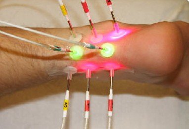 Lokale Lasertherapie der Achillessehne